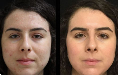 Acne & Pimple Patch